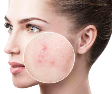 Mụn Bọc Mủ: Nguyên nhân Và Giải Pháp Điều Trị Hiệu Quả