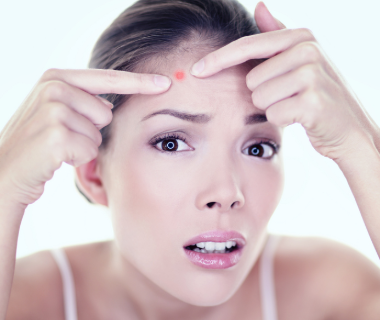 Mụn Ẩn Là Gì? Cách Ngăn Ngừa Và Xử Lý Mụn Ẩn Hiệu Quả