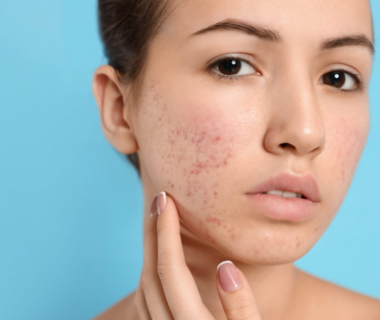 Mụn Là gì? Nặn Mụn Như Nào Cho Đúng Cách 